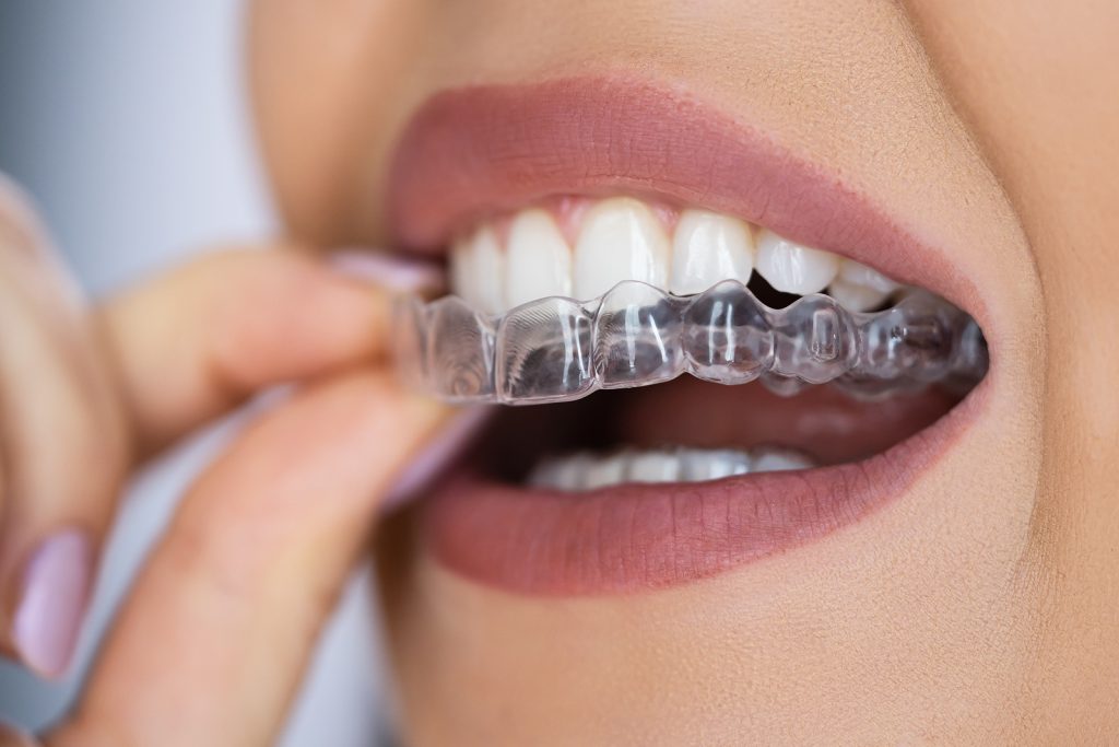 Other Brands Of Clear Aligners