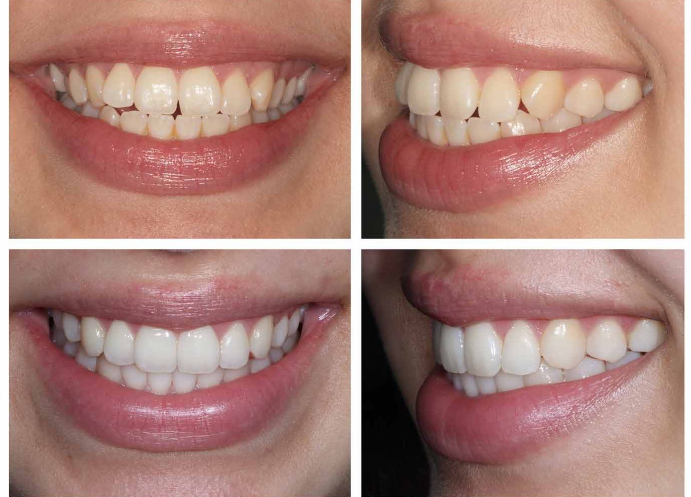 Clear Aligners Services
